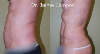 Liposculpture before and after photo