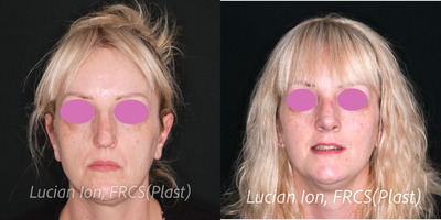 Revision Rhinoplasty before and after photo