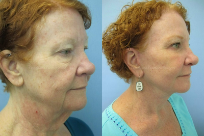 Skin Rejuvenation before and after photo