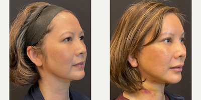 Eyelid Surgery before and after photo