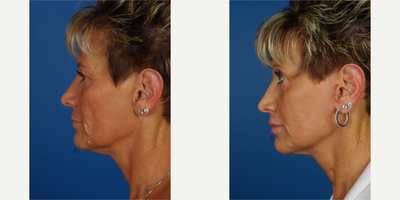 Facelift before and after photo