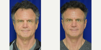 Neck Lift before and after photo