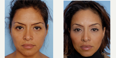 Brow Lift before and after photo