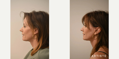 Facelift before and after photo