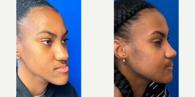 Facial Reconstructive Surgery before and after photo