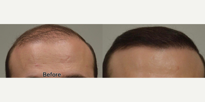 FUE Hair Transplant before and after photo