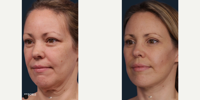 Neck Lift before and after photo