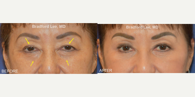 Ptosis Surgery before and after photo