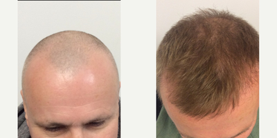 ARTAS Robotic Hair Transplant before and after photo