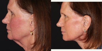 Facelift before and after photo