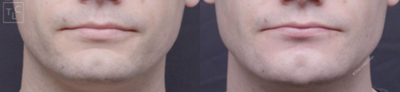 Juvederm before and after photo