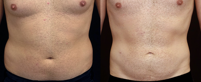Liposuction before and after photo