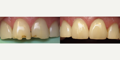Porcelain Veneers before and after photo
