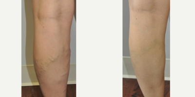 Sclerotherapy before and after photo