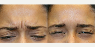 Botox before and after photo