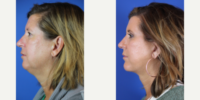 Deep Plane Facelift before and after photo