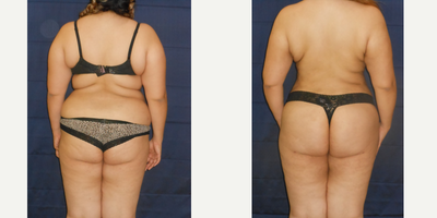 Liposculpture before and after photo