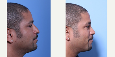 Rhinoplasty before and after photo