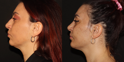 Rhinoplasty before and after photo