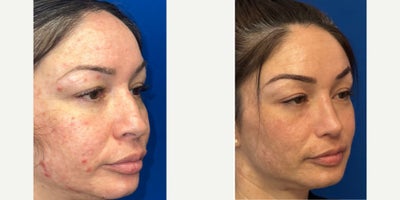 Rhinoplasty before and after photo
