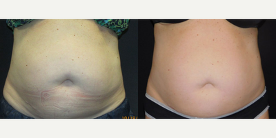 SculpSure before and after photo