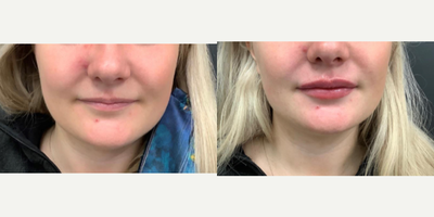 Volbella before and after photo