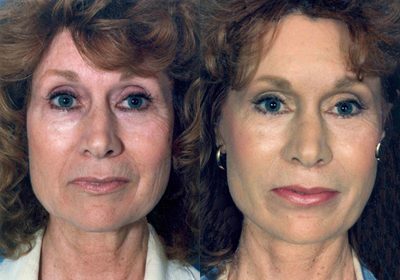 Facelift before and after photo