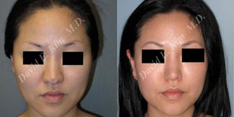 Revision Rhinoplasty before and after photo
