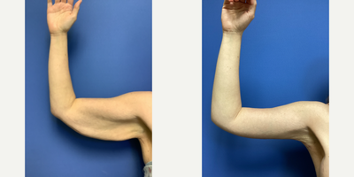 Arm Lift before and after photo