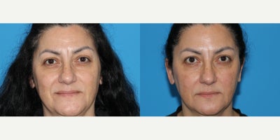 Botox before and after photo