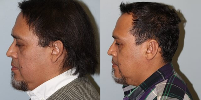 Ear Surgery before and after photo