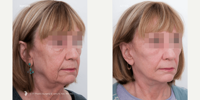 Facelift before and after photo