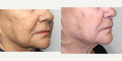 before and after image