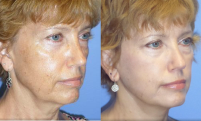Neck Lift before and after photo