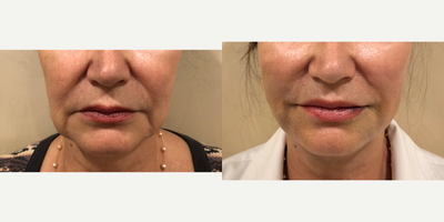 Nonsurgical Facelift before and after photo