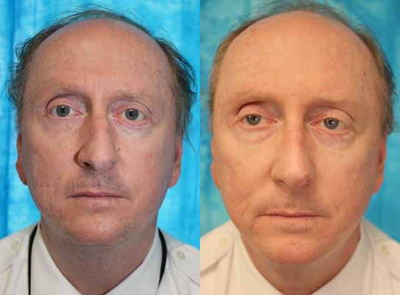 Rhinoplasty before and after photo