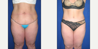 Tummy Tuck before and after photo