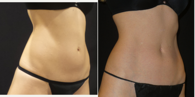 Emsculpt before and after photo