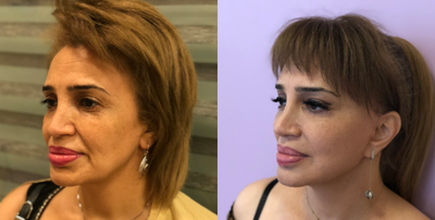 Facelift before and after photo