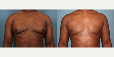 Gynecomastia Surgery before and after photo