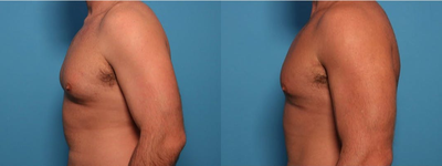 Gynecomastia Surgery before and after photo