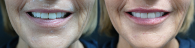 Lip Fillers before and after photo