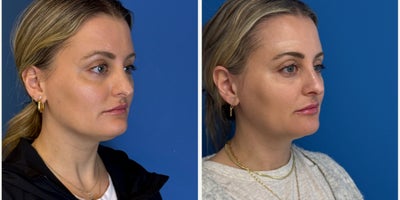Liposuction before and after photo