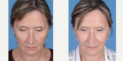 before and after image