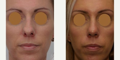 Rhinoplasty before and after photo