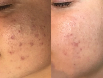 Chemical Peel before and after photo