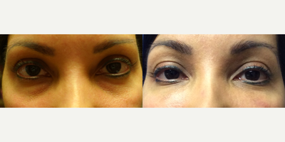 Dermal Fillers before and after photo