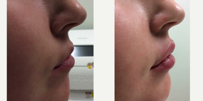 Juvederm before and after photo