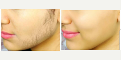 Laser Hair Removal before and after photo