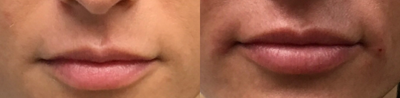 Lip Fillers before and after photo